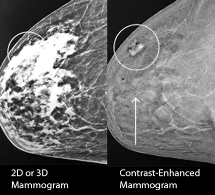 Advanced mammography debuts with your gifts | Kadlec Foundation